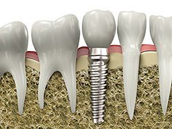 Dental implants