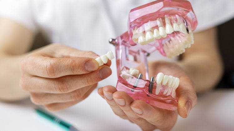 implants for denture