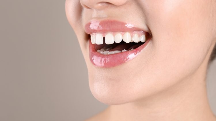 Fix Gaps Between Teeth