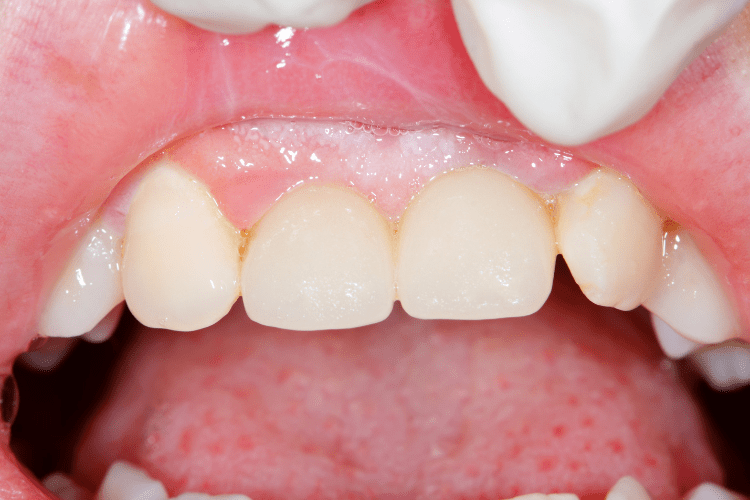 Gum recession treatment