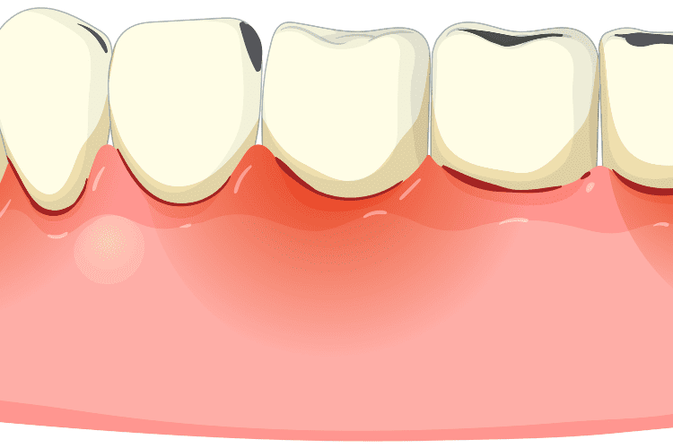 How to reverse gum disease